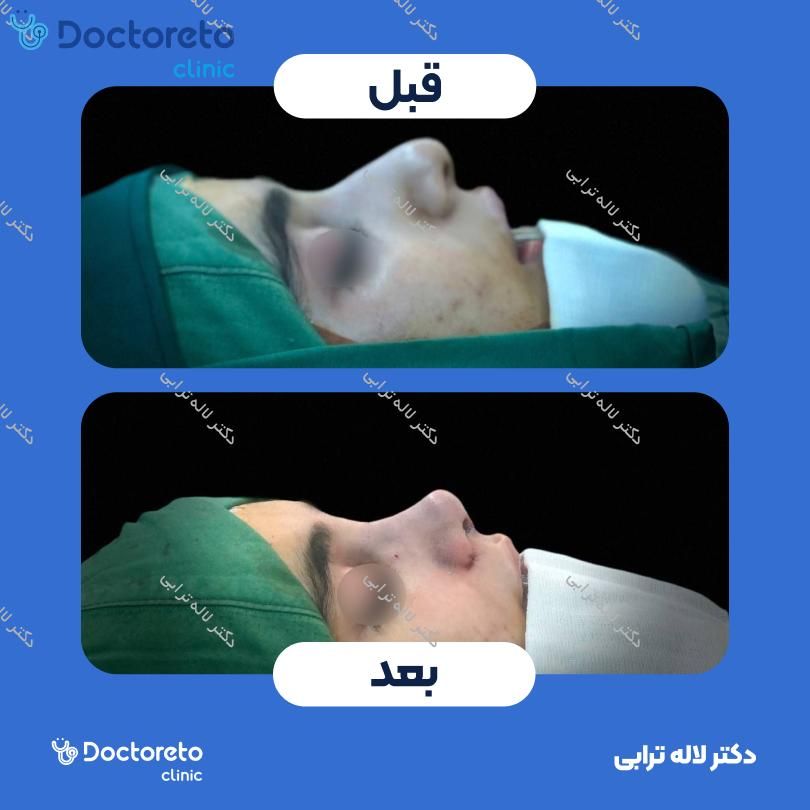 عمل جراحی مجدد زیبایی بینی (رینوپلاستی) دکتر لاله ترابی در رشت 9