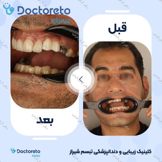 ایمپلنت دیجیتال dio کره ای با روکش (هر واحد) دکتر آرش کرمی در شیراز 106