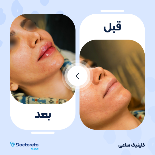 تزریق ژل لب با برند استایلج (1cc)