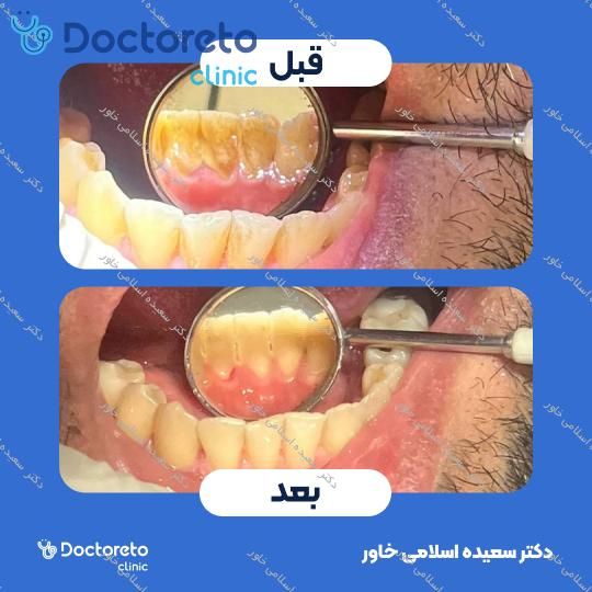 جرمگیری دو فک با بروساژ