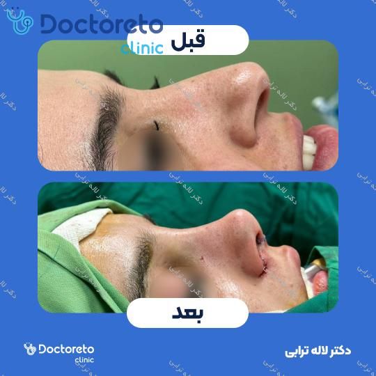 عمل جراحی مجدد زیبایی بینی (رینوپلاستی) دکتر لاله ترابی در رشت 3