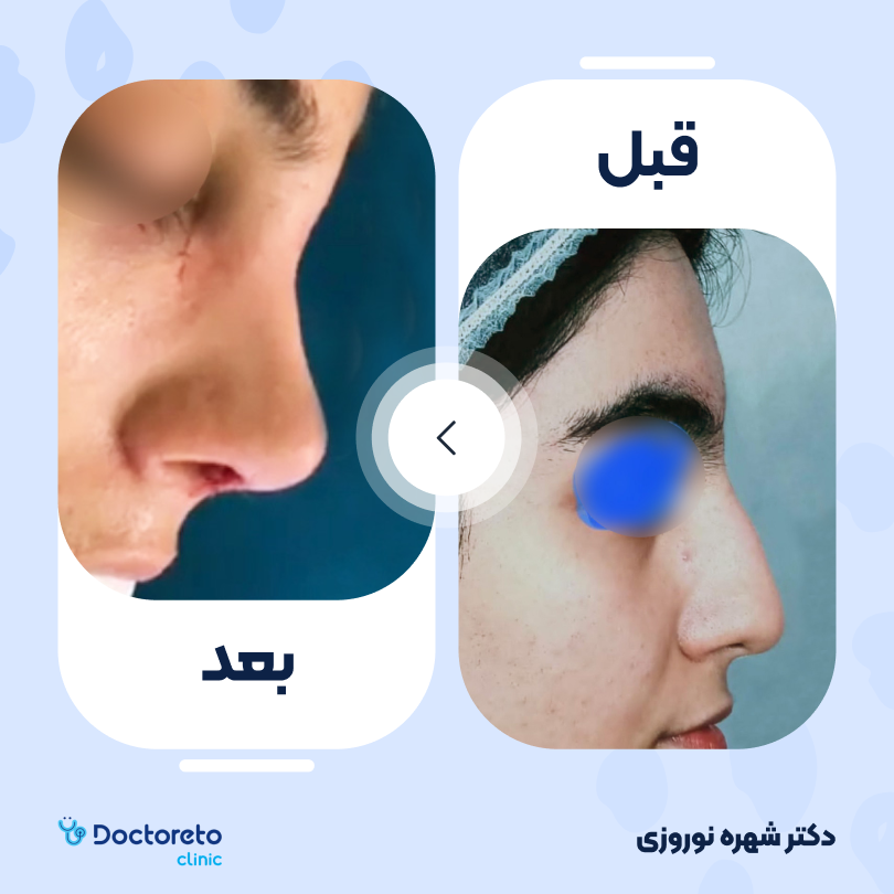 عمل زیبایی بینی (رینوپلاستی) دکتر شهره نوروزی در اهواز 7