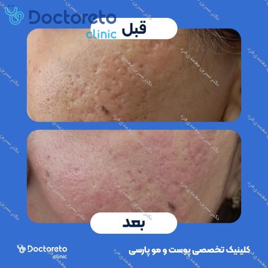 رفع جای جوش، زخم، اسکار و لک صورت با لیزر CO2 آنجلا (هر جلسه)