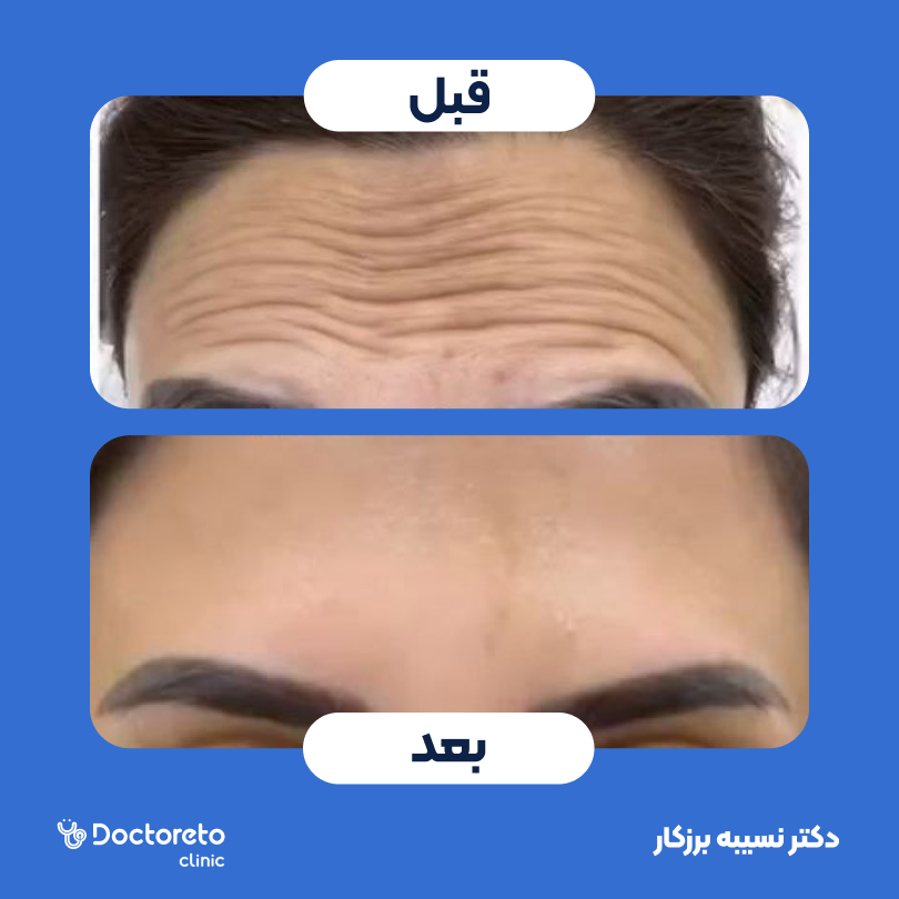 تزریق بوتاکس صورت (پیشانی، خط اخم، دور چشم) با برند مصپورت دکتر نسیبه برزکار در تهران 5