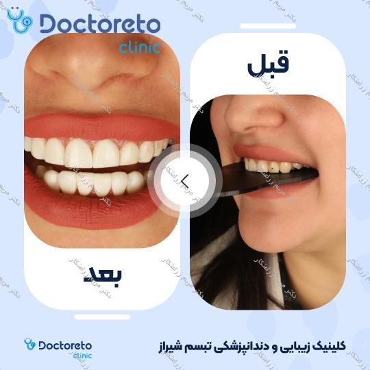 ونیر کامپوزیت توکویاما ژاپنی (هر واحد) دکتر مریم زراعتکار در شیراز 9