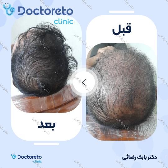 مزوتراپی موی سر با برند رویتاکر (هر جلسه) دکتر بابک رضائی در مهران 5