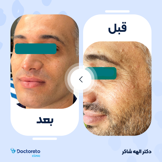 تزریق ژل گونه با برند استایلج (1CC)