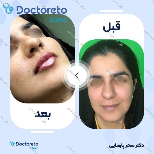 تزریق ژل لب با برند روولاکس (1CC) دکتر سحر پارسایی در مشهد 11