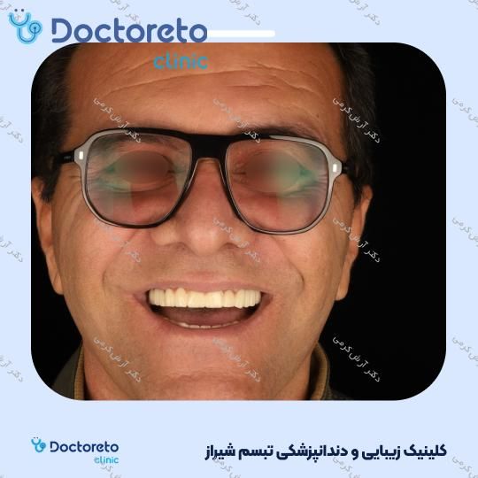 ایمپلنت دیجیتال dio کره ای با روکش (هر واحد) دکتر آرش کرمی در شیراز 71