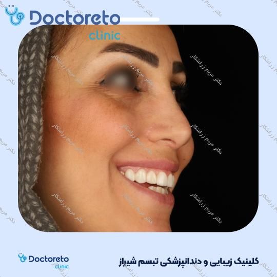 ونیر کامپوزیت توکویاما ژاپنی (هر واحد) دکتر مریم زراعتکار در شیراز 24
