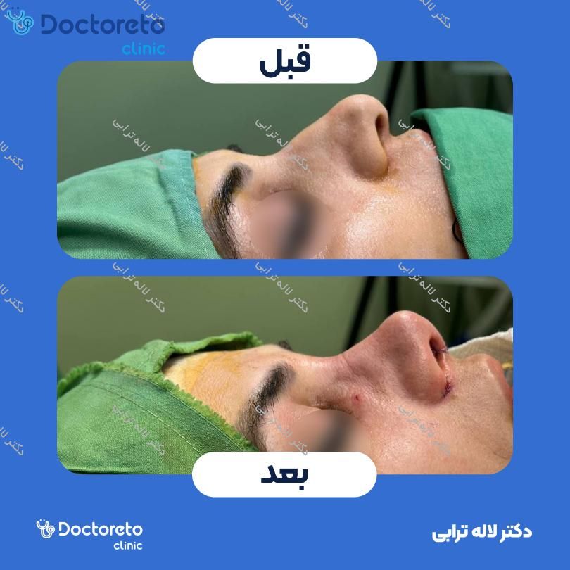 عمل جراحی مجدد زیبایی بینی (رینوپلاستی) دکتر لاله ترابی در رشت 4