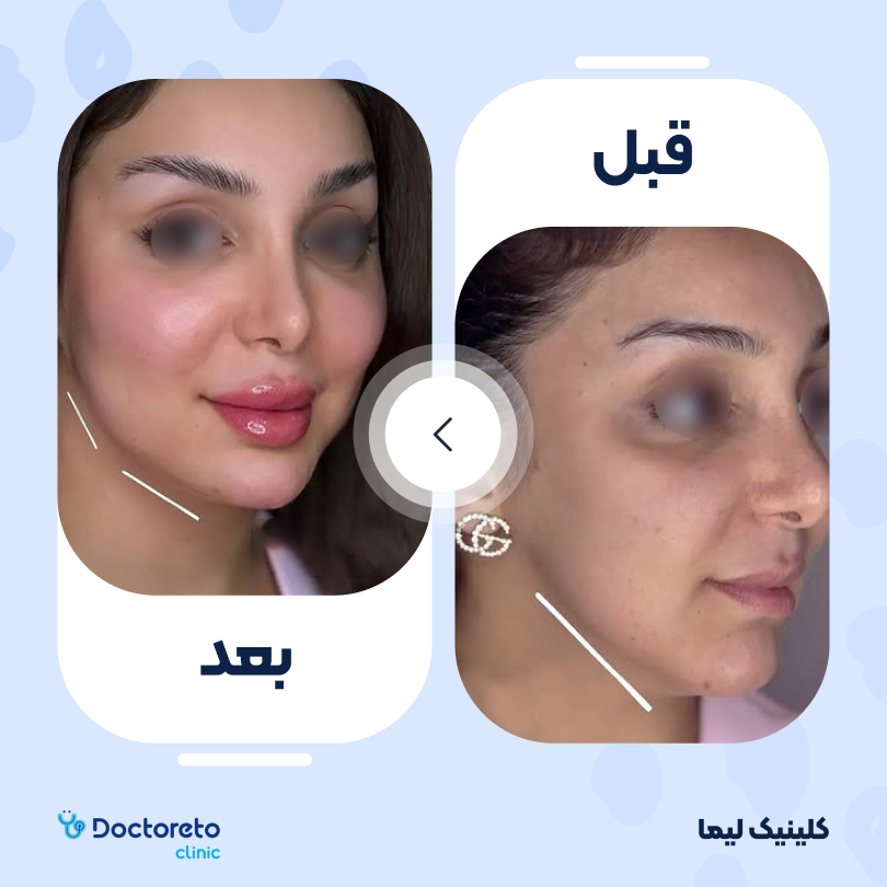 تزریق ژل گونه با برند نئوویا (1cc)