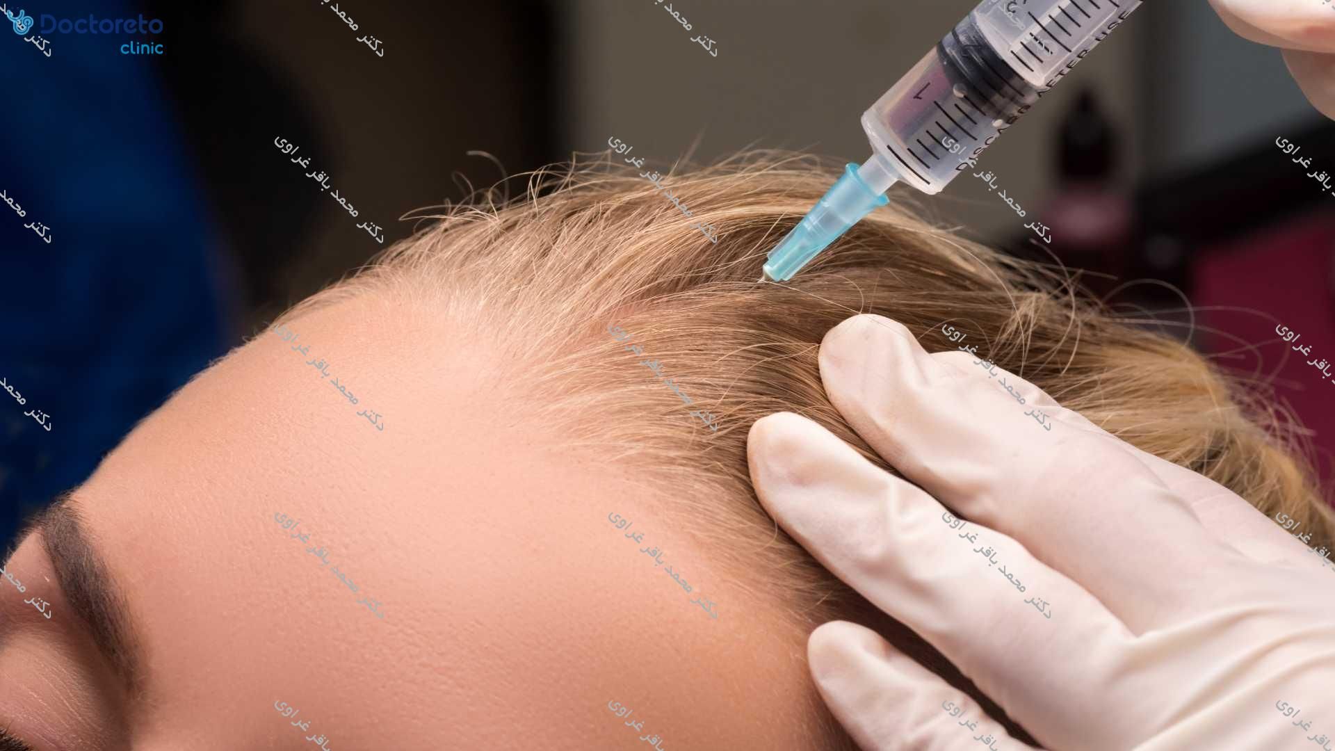 مزوتراپی با کوکتل درمان ریزش موی سر Innoaesthetics HAIR LOSS