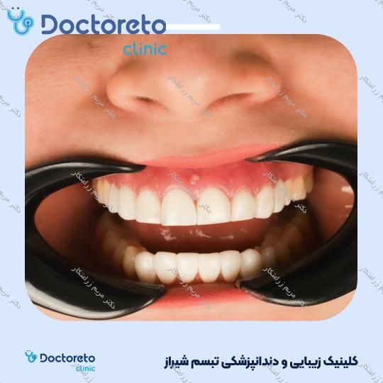 ونیر کامپوزیت توکویاما ژاپنی (هر واحد) دکتر مریم زراعتکار در شیراز 5