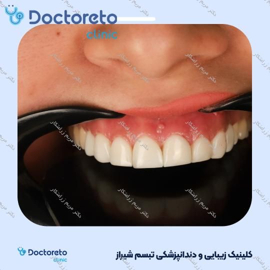 ونیر کامپوزیت توکویاما ژاپنی (هر واحد) دکتر مریم زراعتکار در شیراز 2