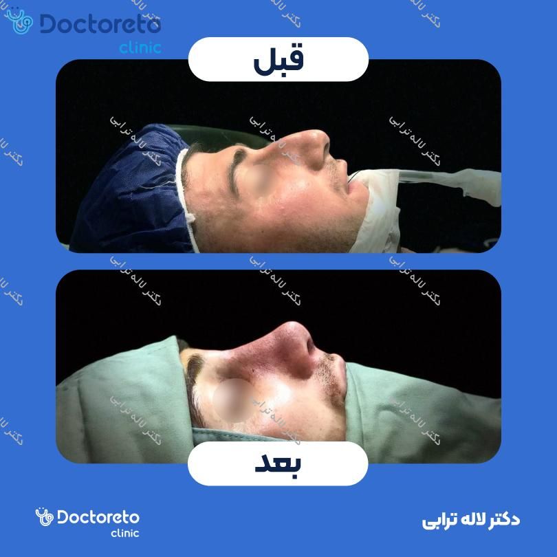 عمل جراحی مجدد زیبایی بینی (رینوپلاستی) دکتر لاله ترابی در رشت 8