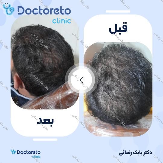 مزوتراپی موی سر با برند رویتاکر (هر جلسه) دکتر بابک رضائی در مهران 3