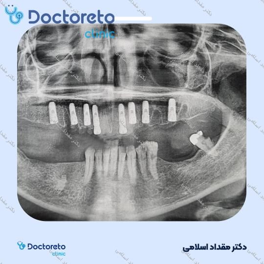 ایمپلنت اشترومن سوئیسی تیتانیوم با روکش ( هرواحد ) دکتر مقداد اسلامی در تهران 4