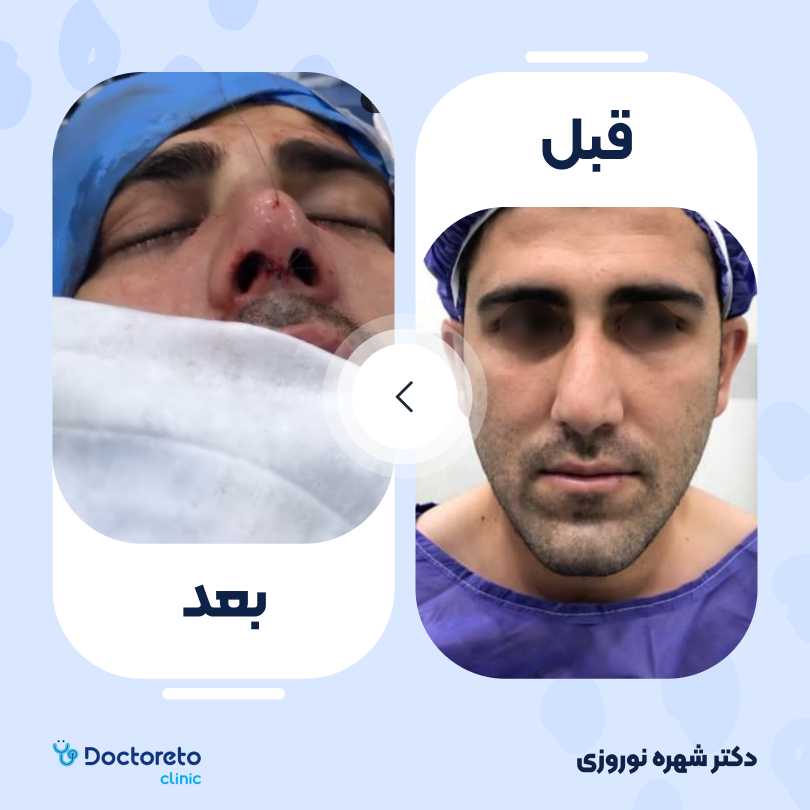 عمل زیبایی بینی (رینوپلاستی) دکتر شهره نوروزی در اهواز 2