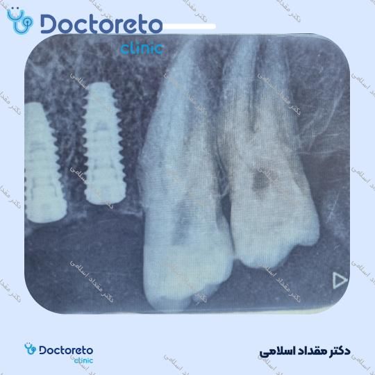 سینوس لیفت باز