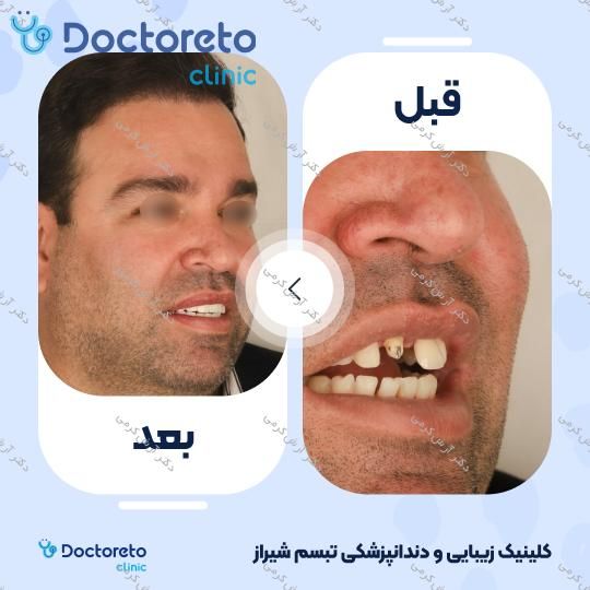 ایمپلنت دیجیتال دنتیس کره ای با روکش (هر واحد) دکتر آرش کرمی در شیراز 30