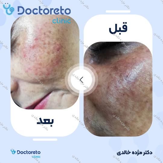 مزونیدلینگ صورت با ماده ترانزامیک (هر جلسه)