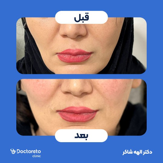 تزریق ژل گونه با برند استایلج (1CC)