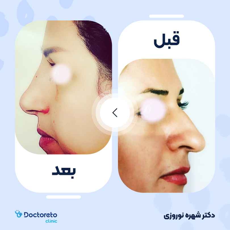 عمل زیبایی بینی (رینوپلاستی) دکتر شهره نوروزی در اهواز 5