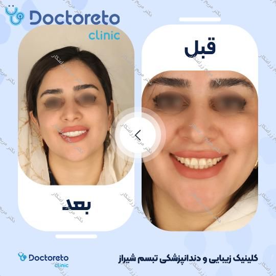 ونیر کامپوزیت توکویاما ژاپنی (هر واحد) دکتر مریم زراعتکار در شیراز 18