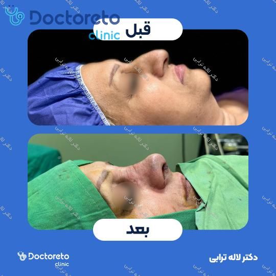 عمل جراحی مجدد زیبایی بینی (رینوپلاستی) دکتر لاله ترابی در رشت 5