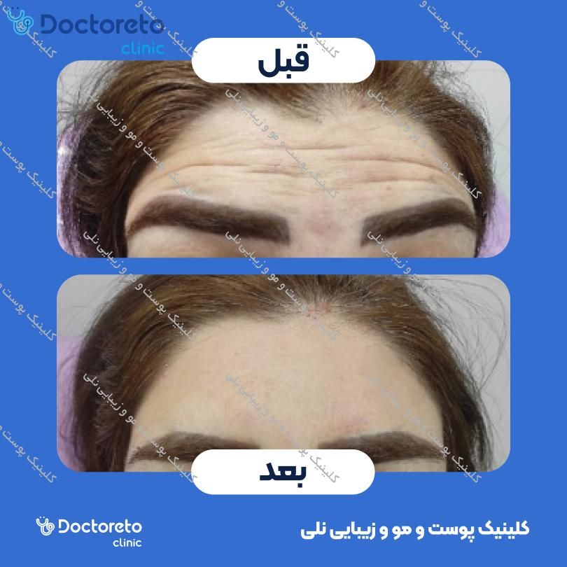 تزریق بوتاکس صورت (پیشانی، خط اخم، پنجه کلاغی) با برند دیستون کلینیک پوست و مو و زیبایی نلی در شیراز 4