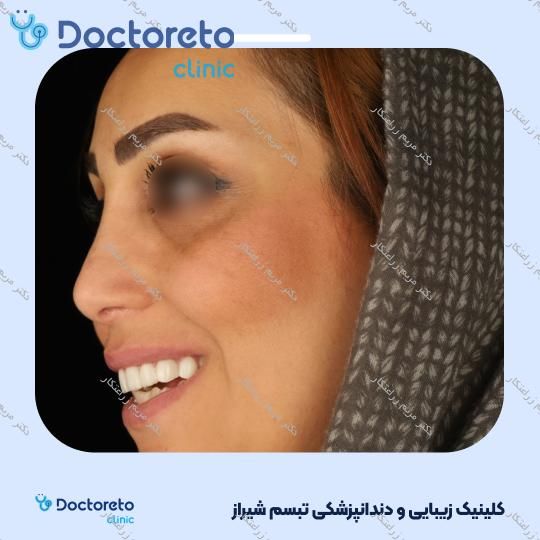 ونیر کامپوزیت توکویاما ژاپنی (هر واحد) دکتر مریم زراعتکار در شیراز 23