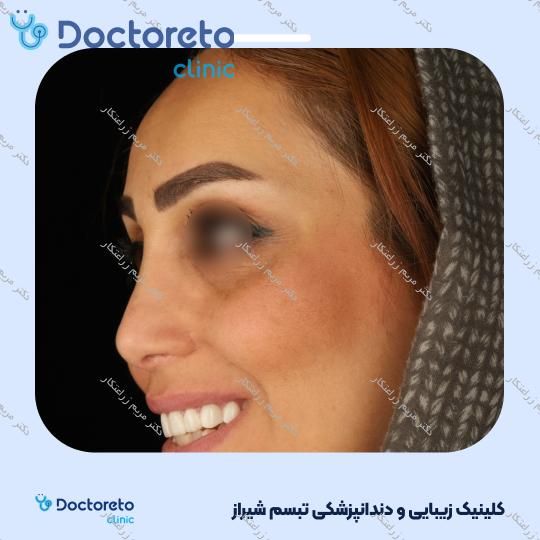 ونیر کامپوزیت توکویاما ژاپنی (هر واحد) دکتر مریم زراعتکار در شیراز 21