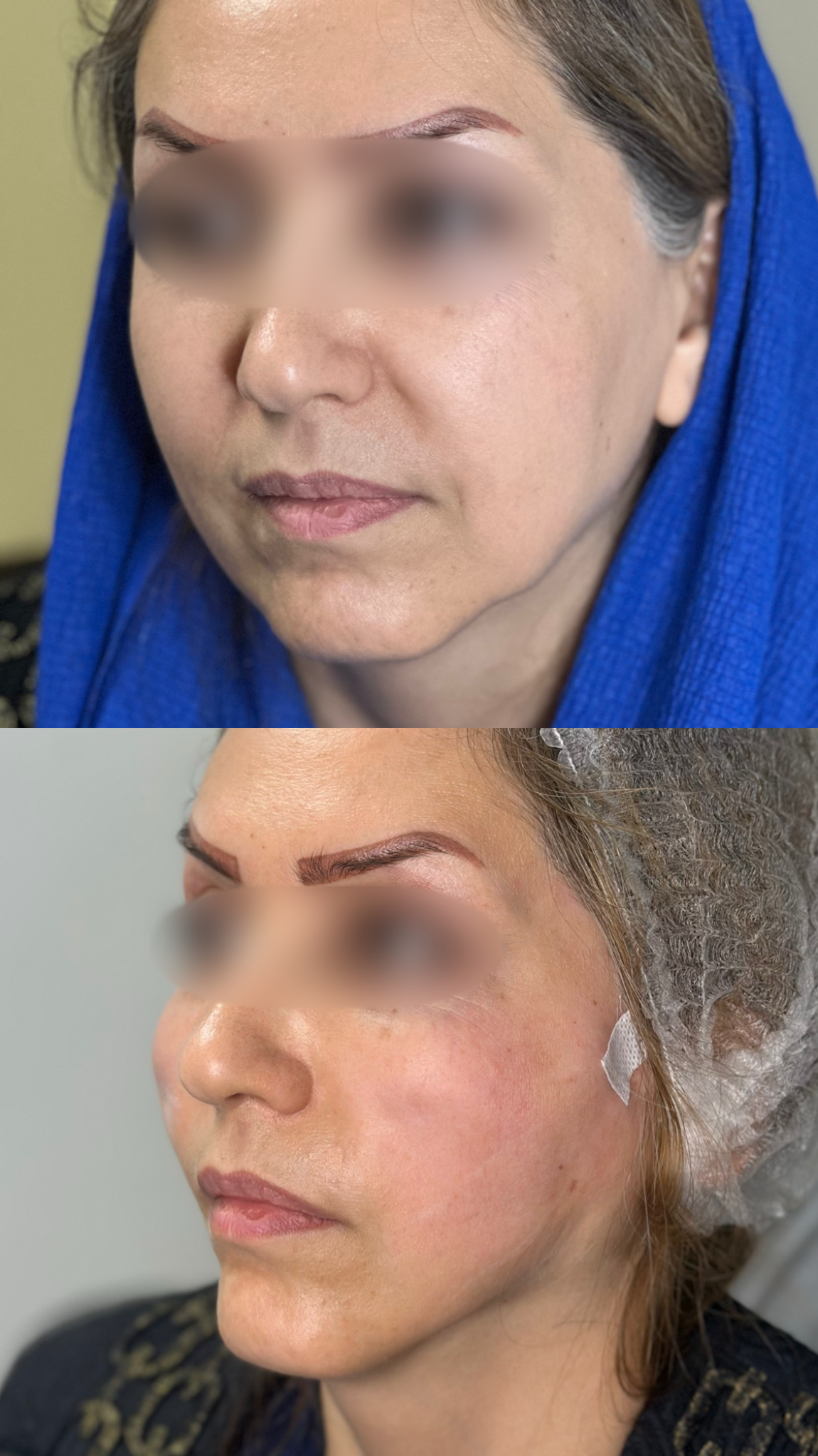 لیفت صورت و ابرو با استفاده از نخ مکس لیفت کره جنوبی (10 عدد)