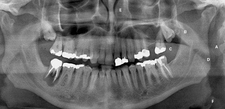 عکس رادیولوژی OPG دندان