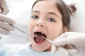کشیدن دندان شیری عقبی (بدون جراحی)