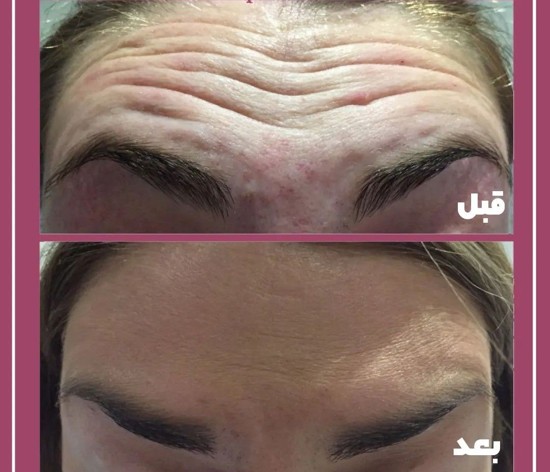 تزریق بوتاکس صورت (پیشانی، خط اخم، خطوط پنجه کلاغی) با برند مصپورت 🌷 (عید نوروز)