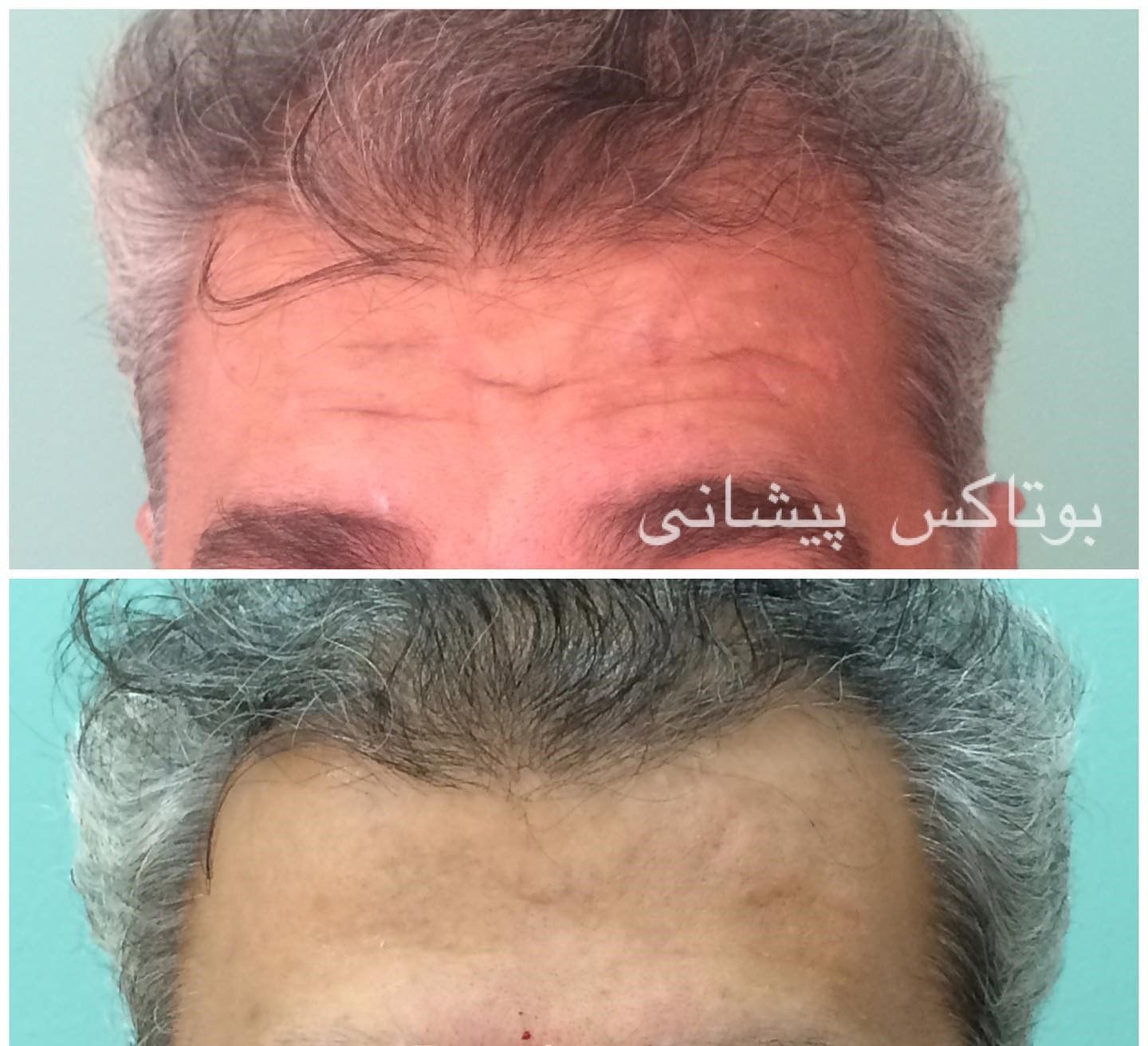 تزریق بوتاکس صورت (پیشانی، خط اخم و پنجه کلاغی) با برند مصپورت 🌷 (عید نوروز) دکتر طاهره دلپذیر در شیراز 2