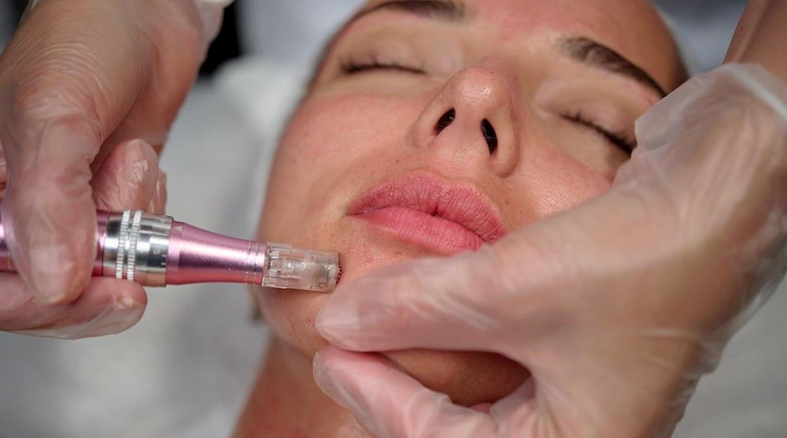 مزونیدلینگ صورت برای جوانسازی و لیفت صورت و پیشگیری از افتادگی پوست با برند فیوژن (هر جلسه 2 cc) دکتر آذین رفیعی پور در اصفهان 1