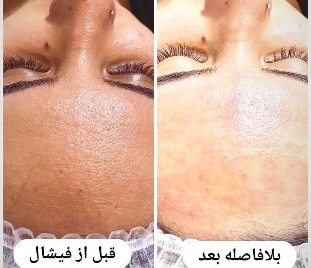 فیشیال (پاکسازی) کل صورت (هر جلسه) دکتر فاطمه قدرتی در شیراز 2