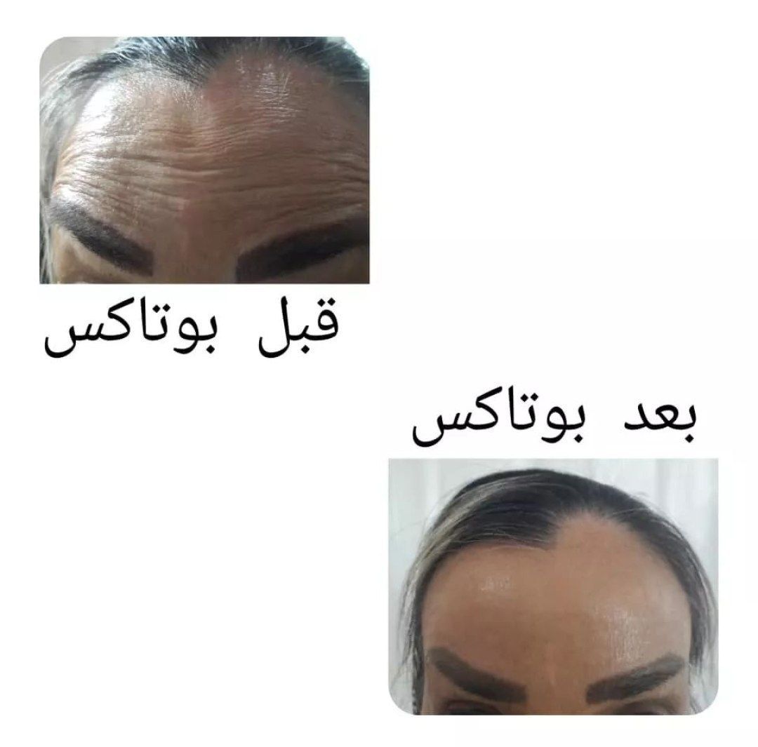 تزریق بوتاکس صورت (پیشانی، خط اخم، پنجه کلاغی) با برند مصپورت 🌷 (عید نوروز) دکتر علی رستم زاده در اصفهان 2