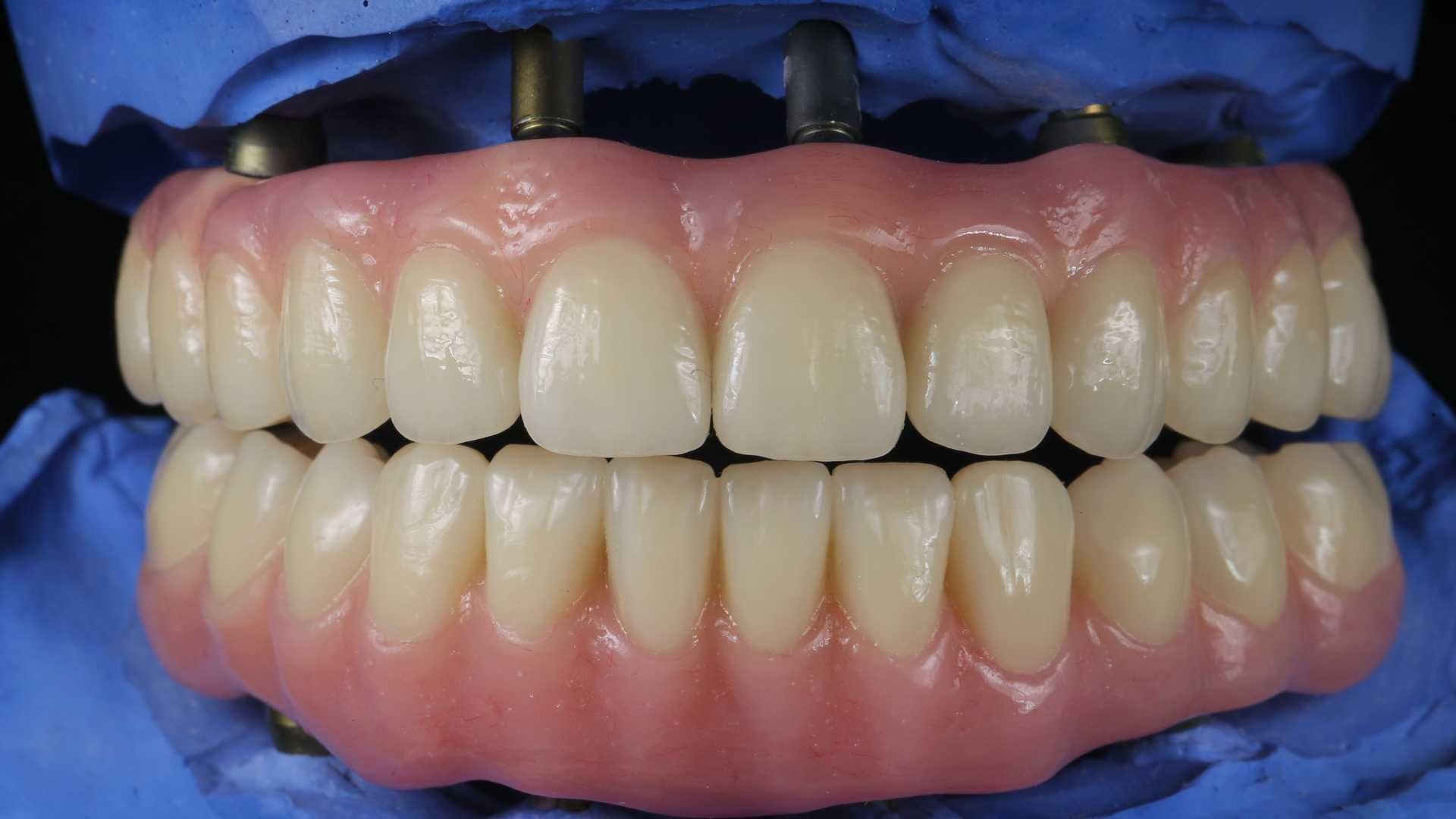 دندان پروتز متحرک آلمانی (دندان مصنوعی کامل) دو فک