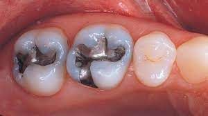 پرکردن دندان یک سطحی با آمالگام دکتر سهیل جابری نسب در تهران 1