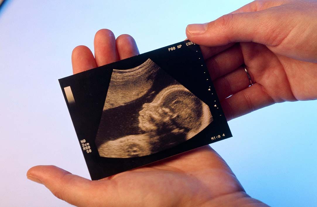 سونوگرافی دوران بارداری (غربالگری مرحله دوم ،آنومالی اسکن)
