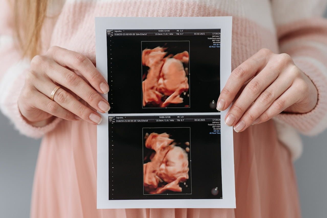 سونوگرافی دوران بارداری ( کالر داپلر بارداری)