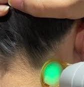 لیز موهای زائد بانوان (گردن) بادستگاه دایود رکسانا آیس دکتر الهه شاکر در ارومیه 1