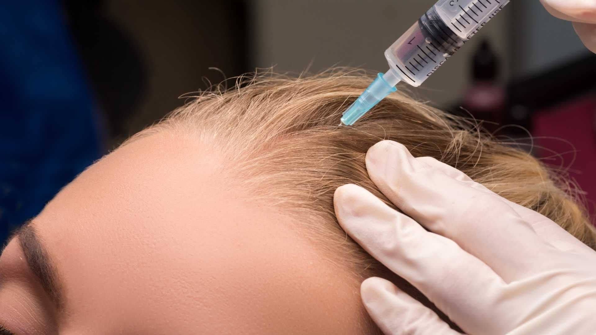 مزوتراپی موی سر با برند فیوژن دکتر شیوا ظهیراعظمی در کرج 1