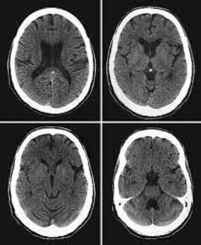 سی تی اسکن مغز بیمارستان تندیس در تهران 1