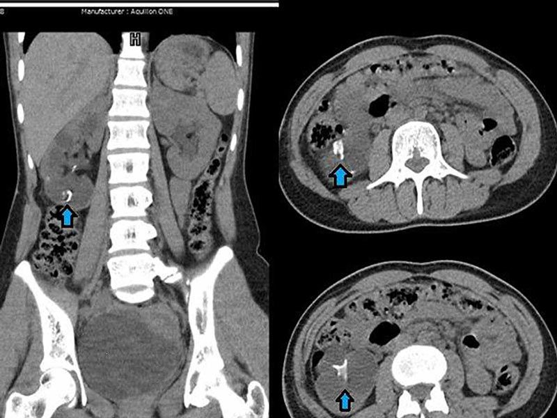 سی تی اسکن سنگ کلیه ،شکم و لگن