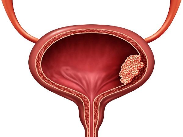 جراحی توده مثانه از طریق مجاری ادراری دکتر امیر فرخی در شیراز 1